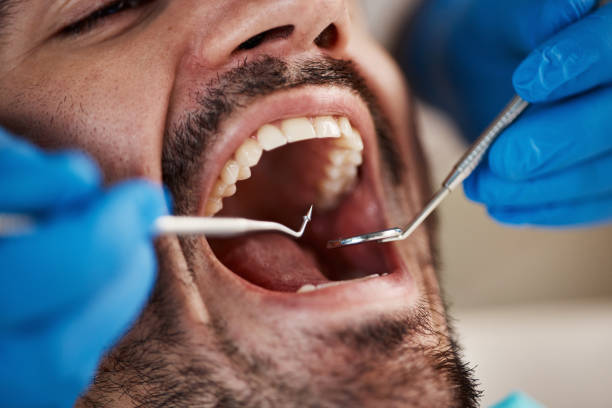 Best Dental Fillings (Composite and Amalgam)  in Fostoria, OH
